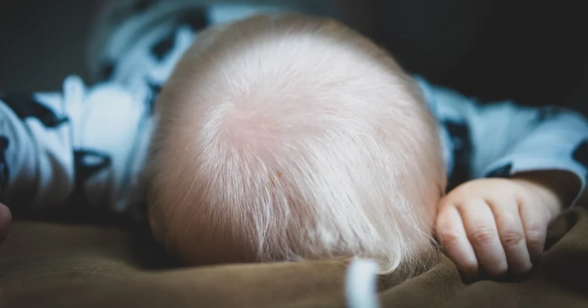 Flat Head Syndrome (Positional Plagiocephaly): Causes, Prevention, Treatment